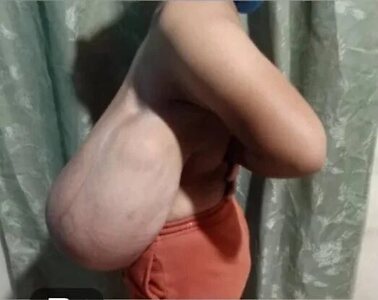 Gigantomastia